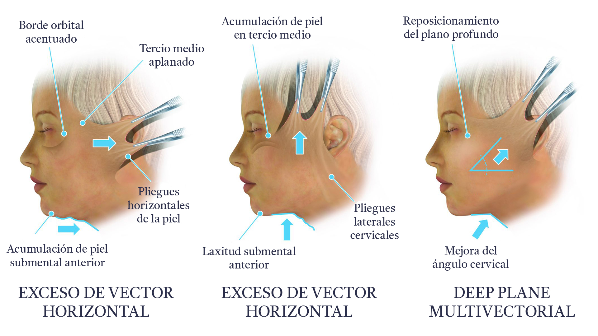Vectores
