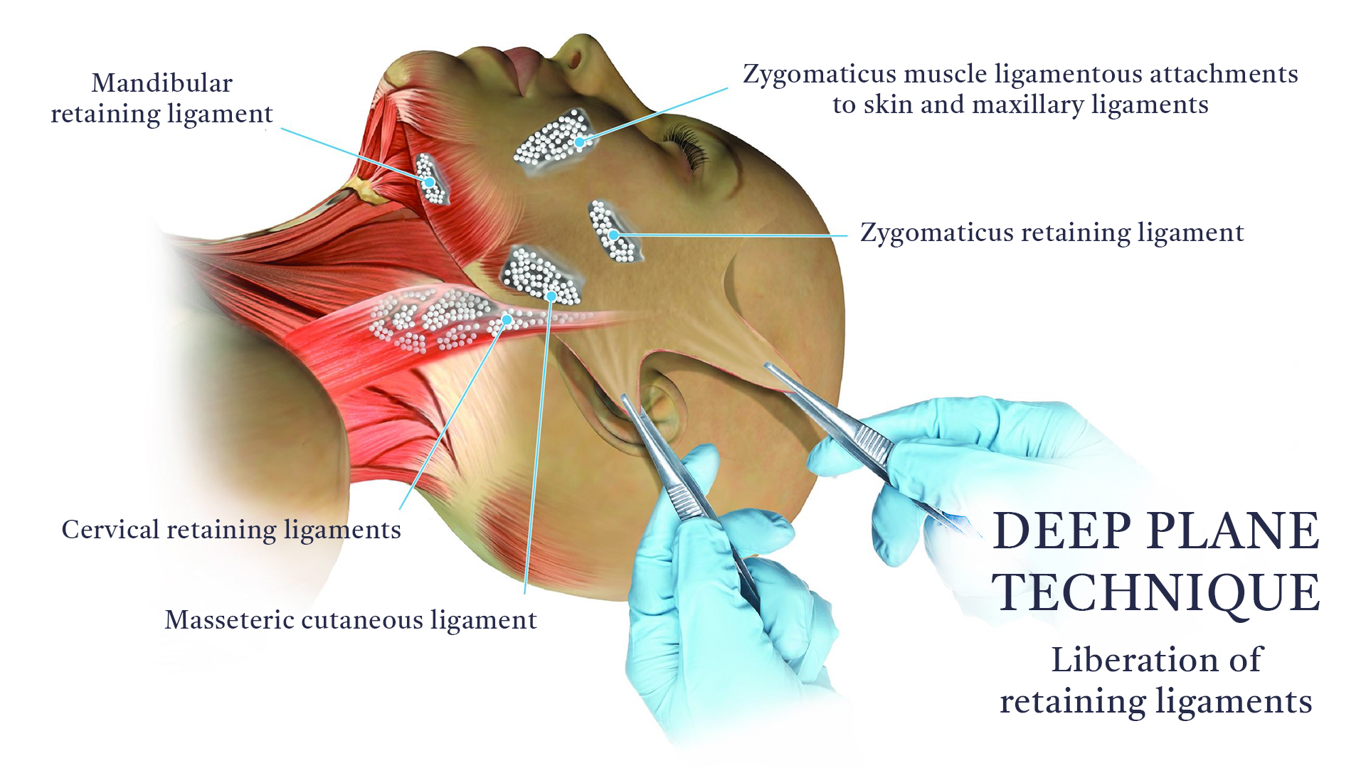 tecnica-deep-plane-EN