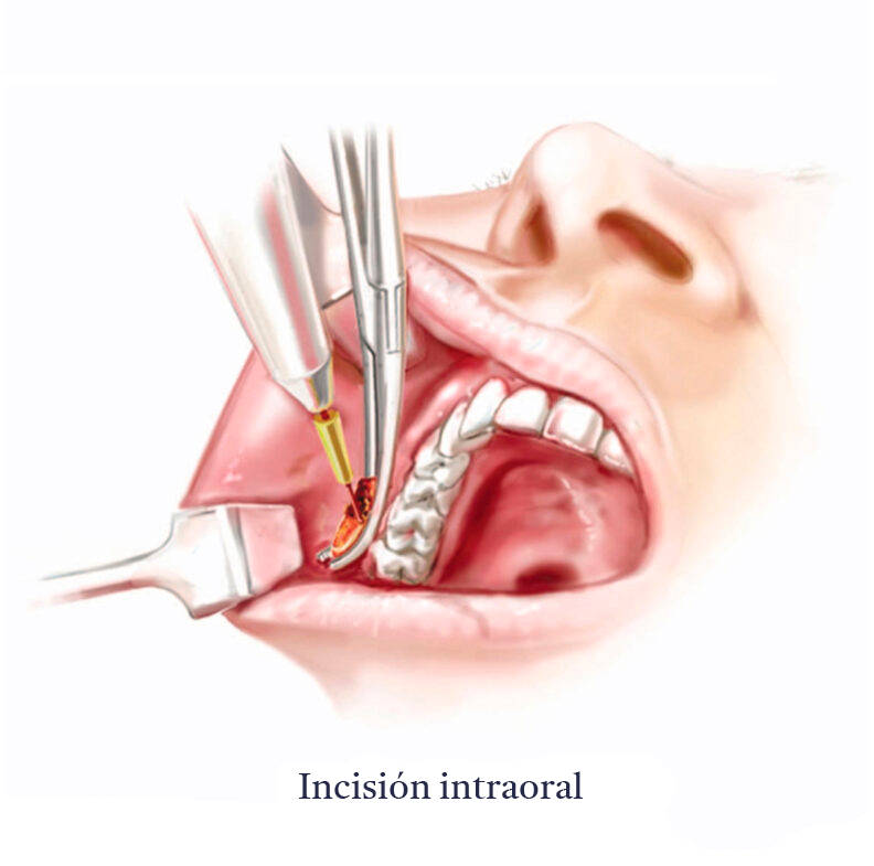 Bichectomia-Anatomia-B