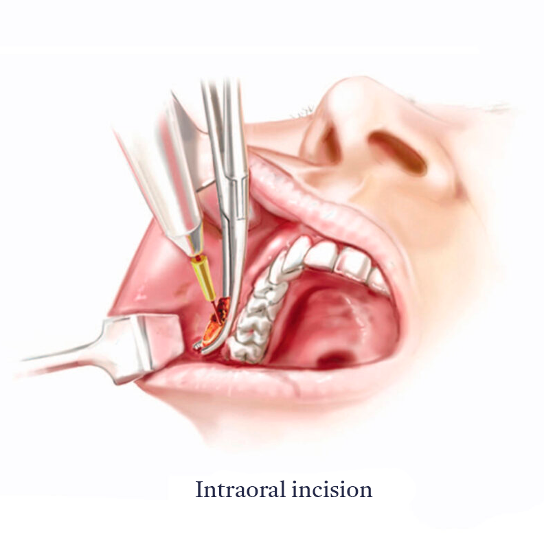 Bichectomy-Anatomy-B