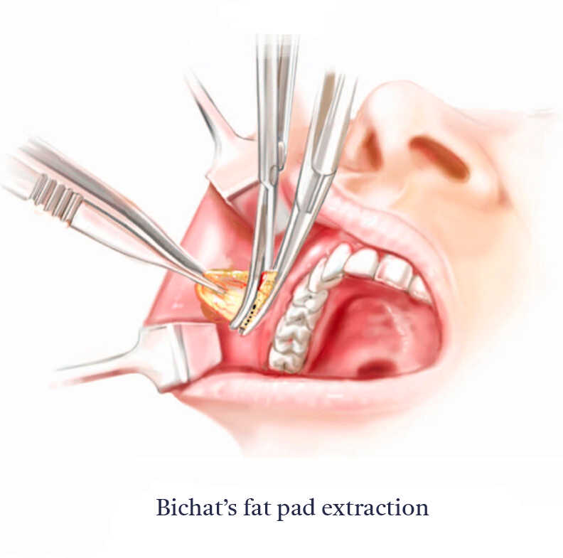 Bichectomy-Anatomy-C