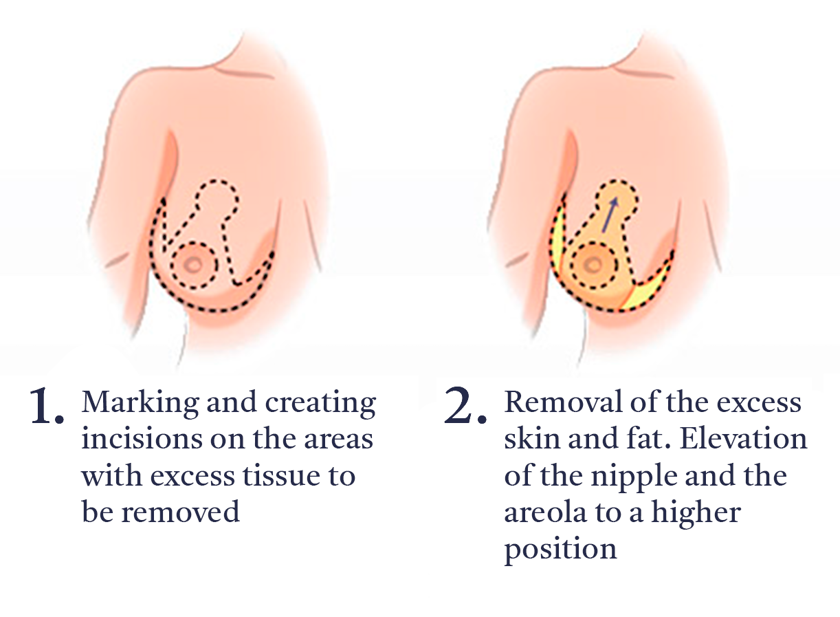 Breast Reduction Diagram A