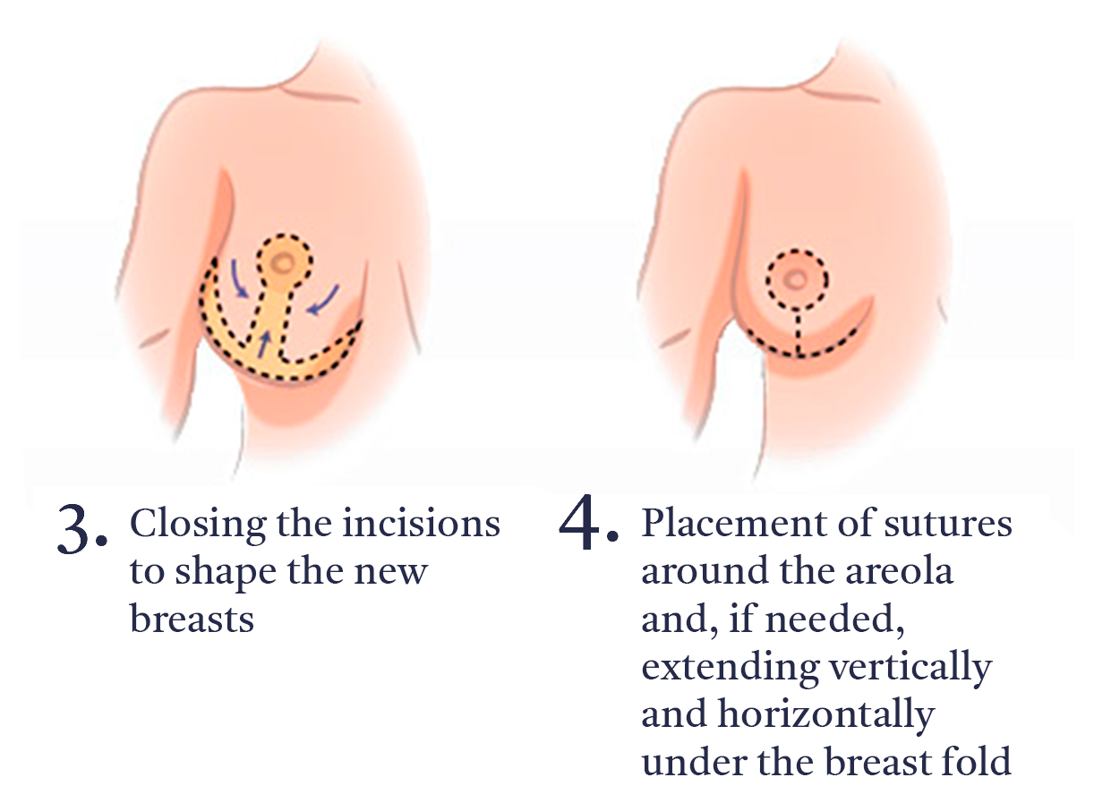 Breast Reduction Diagram B