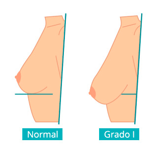 grados-de-ptosis1.png