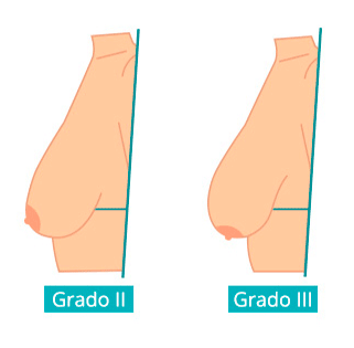 grados-de-ptosis2.png