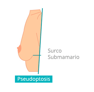 grados-de-ptosis3.png