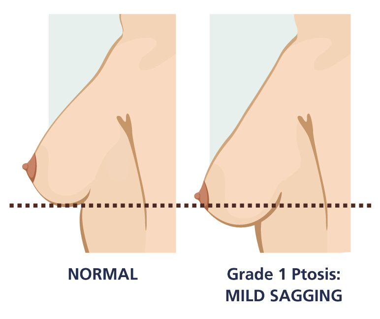 ptosis-grades-A