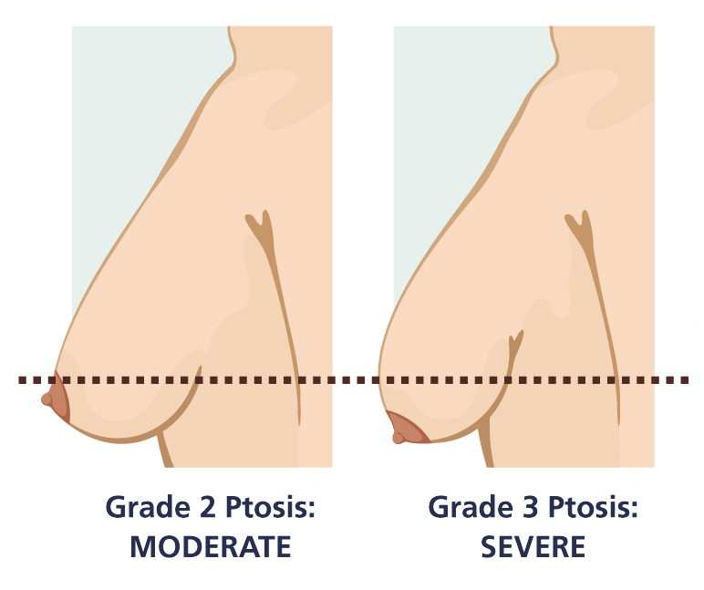 ptosis-grades-B