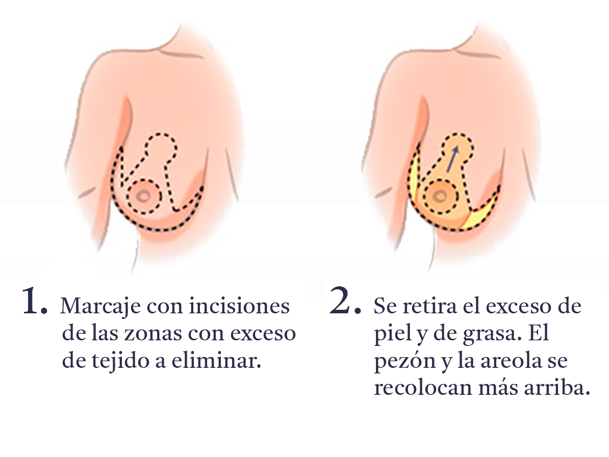 reduccion-de-mamas-pasos-A