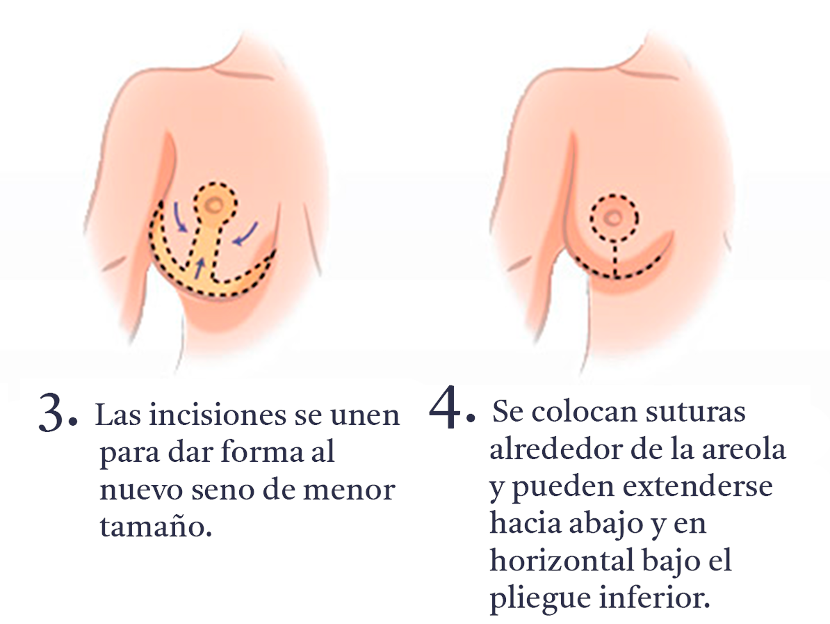 reduccion-de-mamas-pasos-B