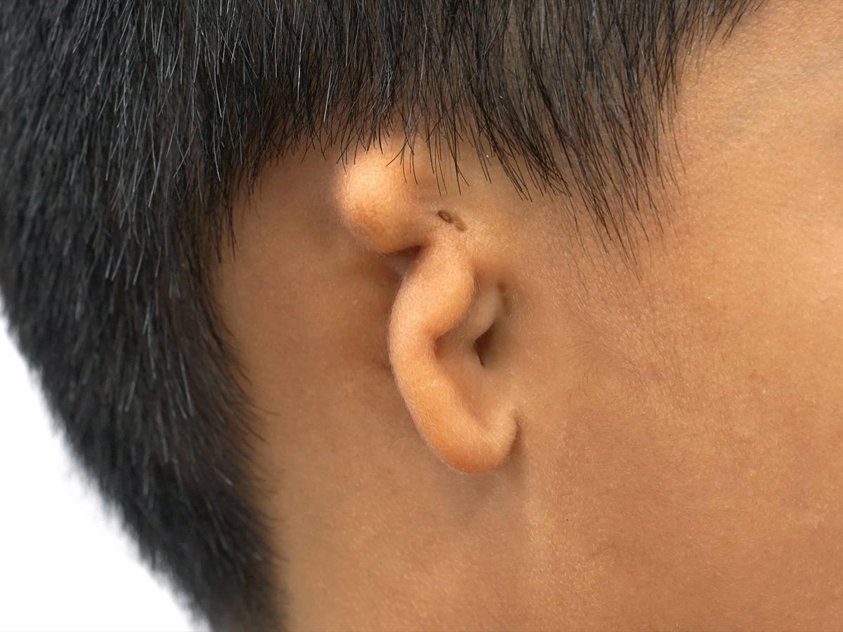 microtia.jpg