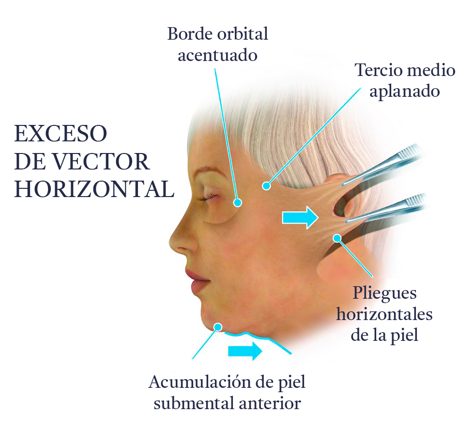 ExcesoHorizontal