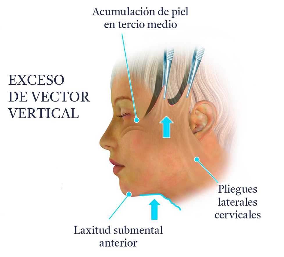 ExcesoVertical