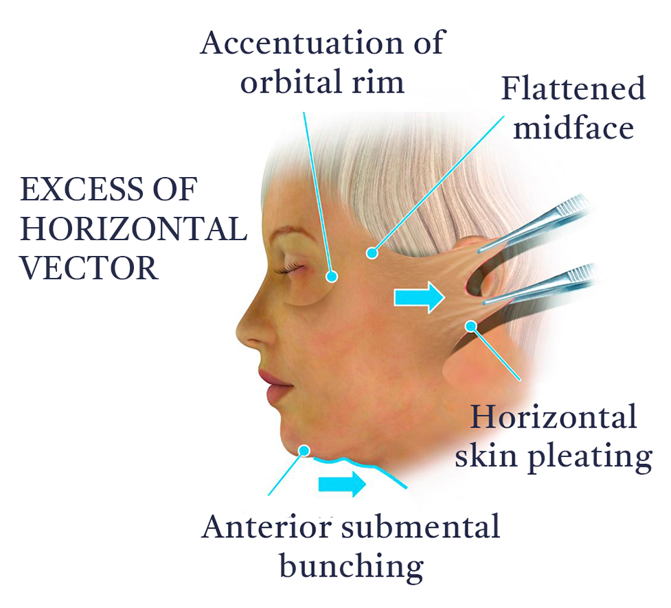 ExcessHorizontal