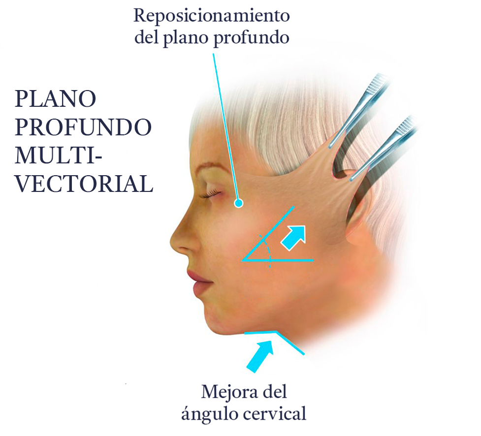 MultiVectorial