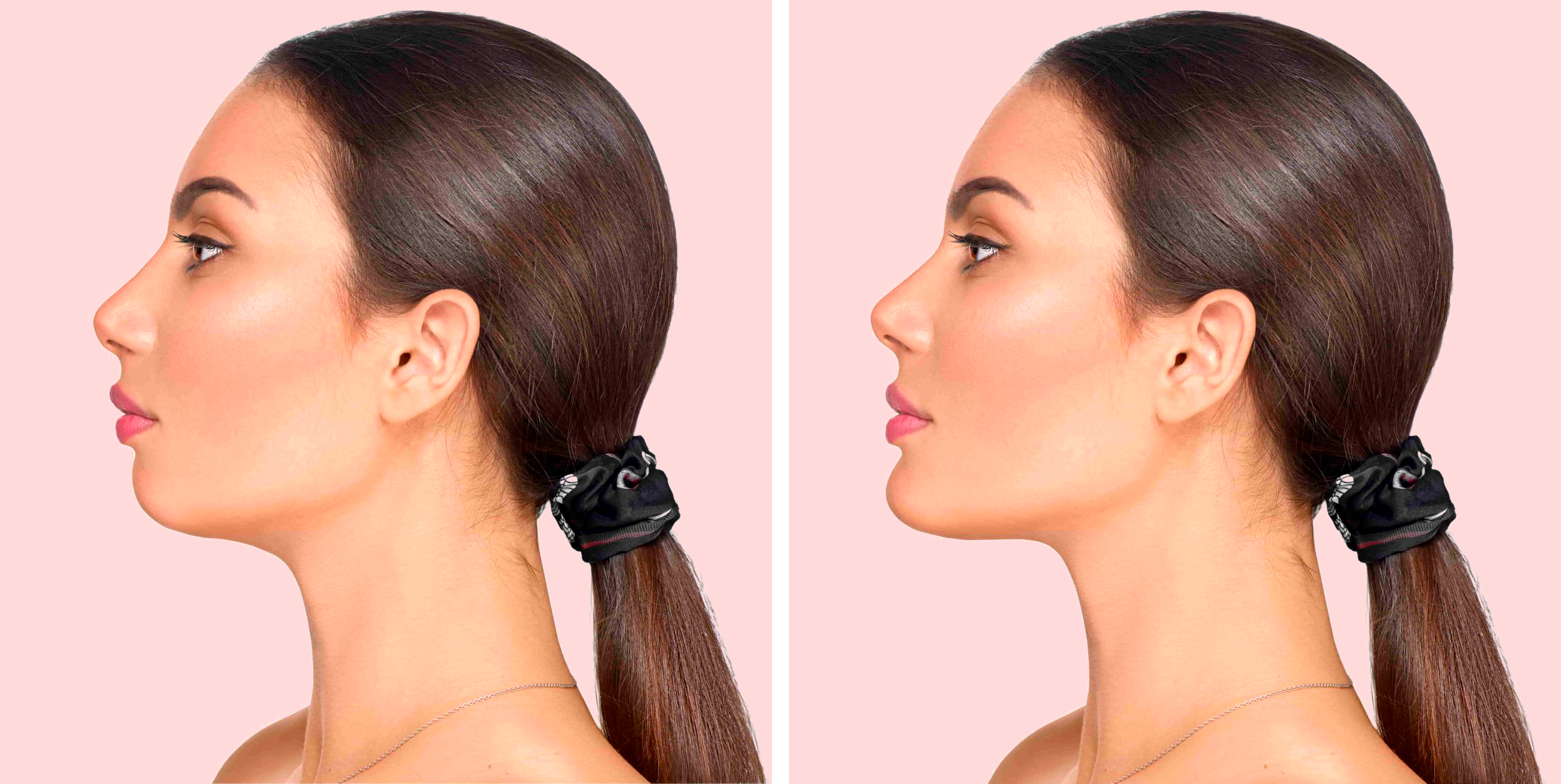 mentoplastia-antes-despues-chica