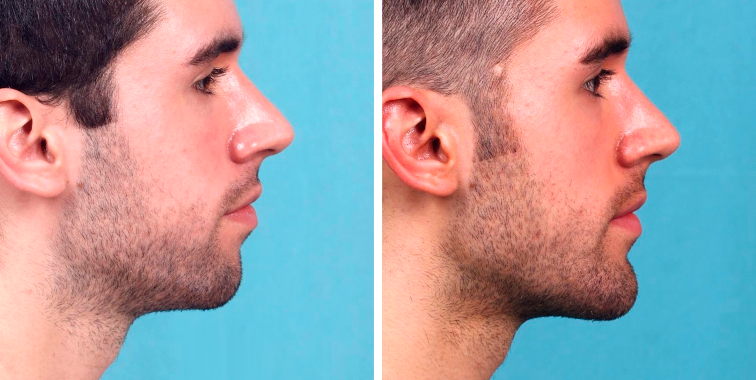 mentoplastia-antes-despues-chico
