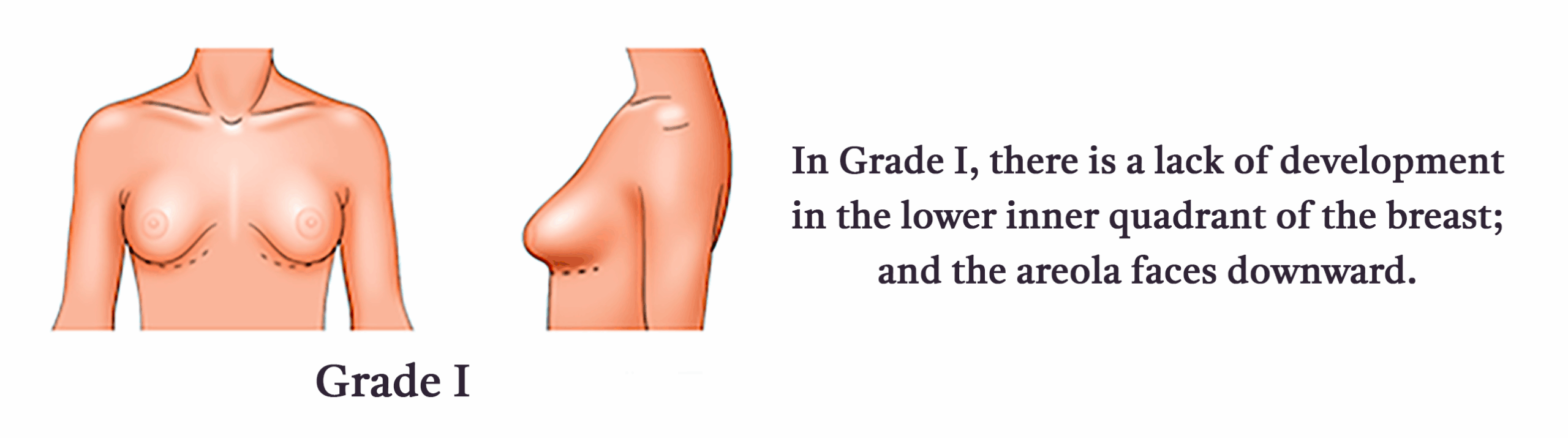Grade-I