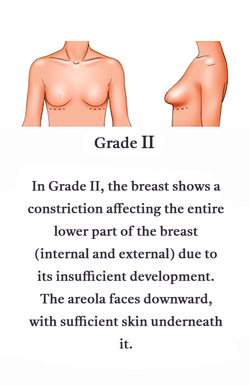 Grade-II-Mobile