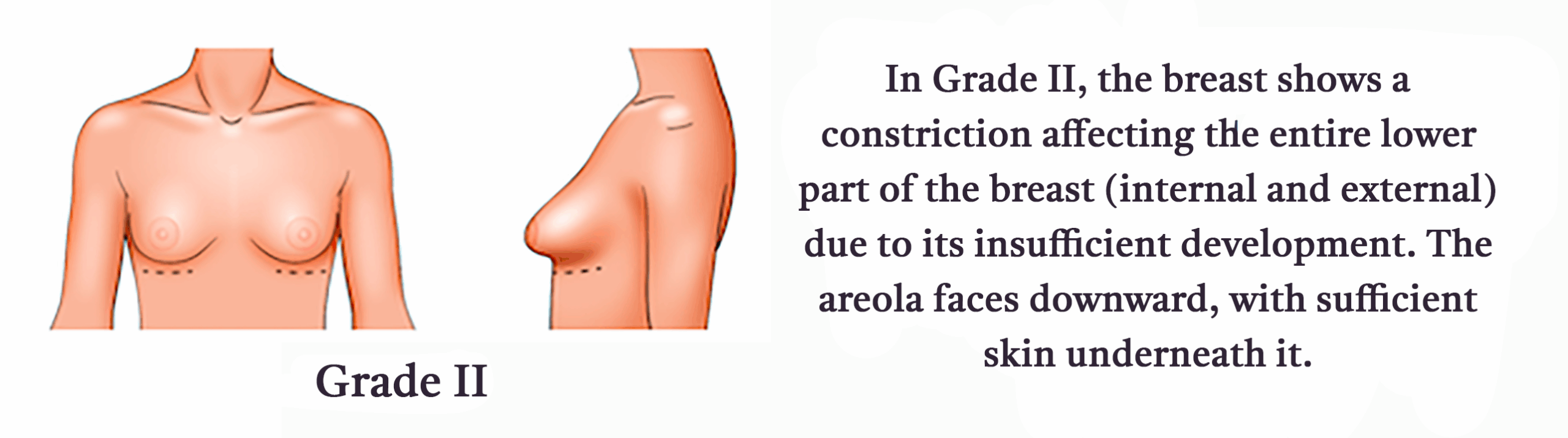 Grade-II