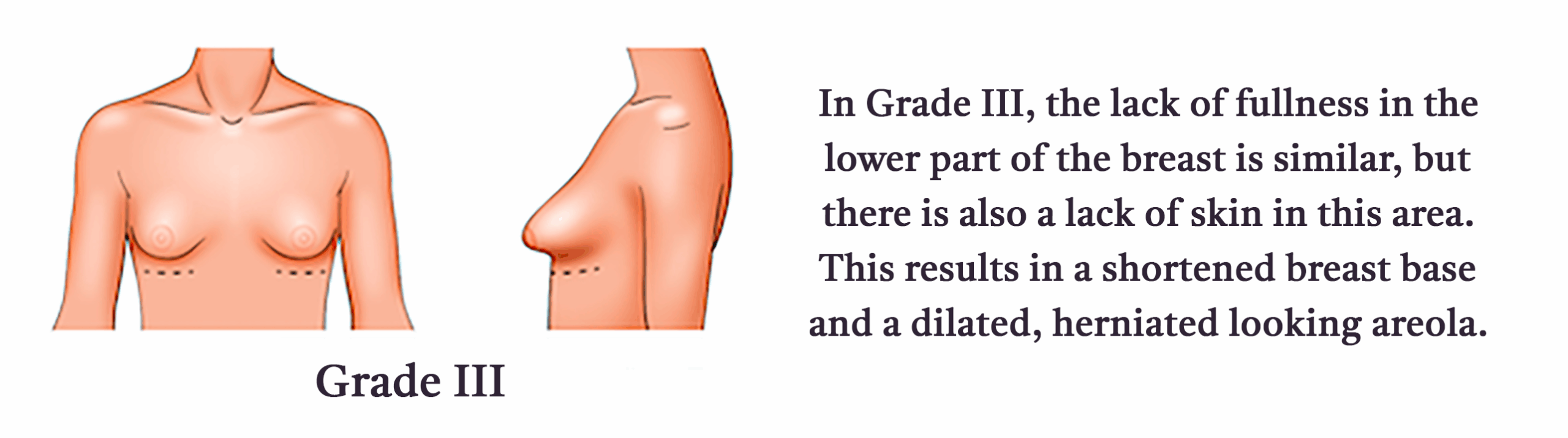 Grade-III