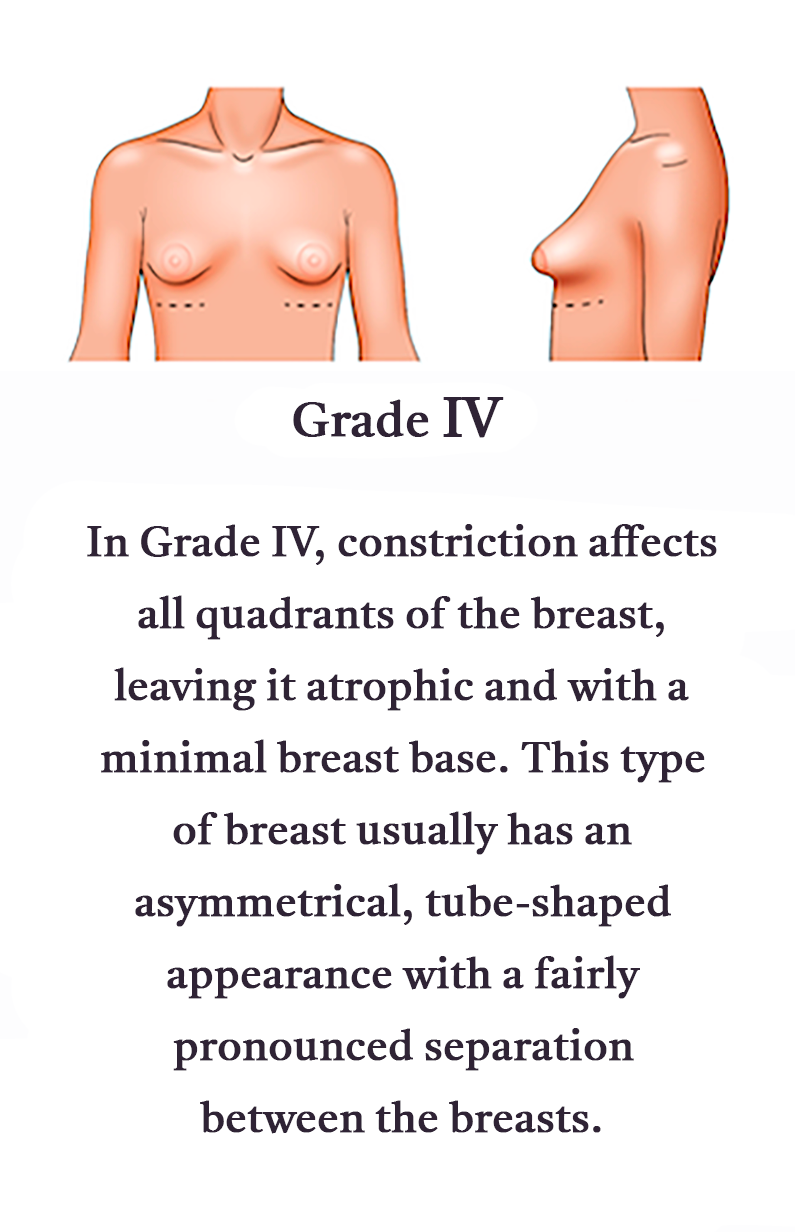 Grade-IV-Mobile