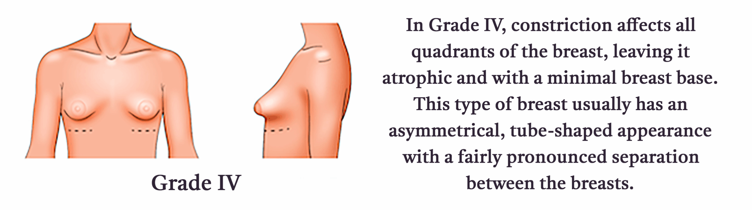Grade-IV