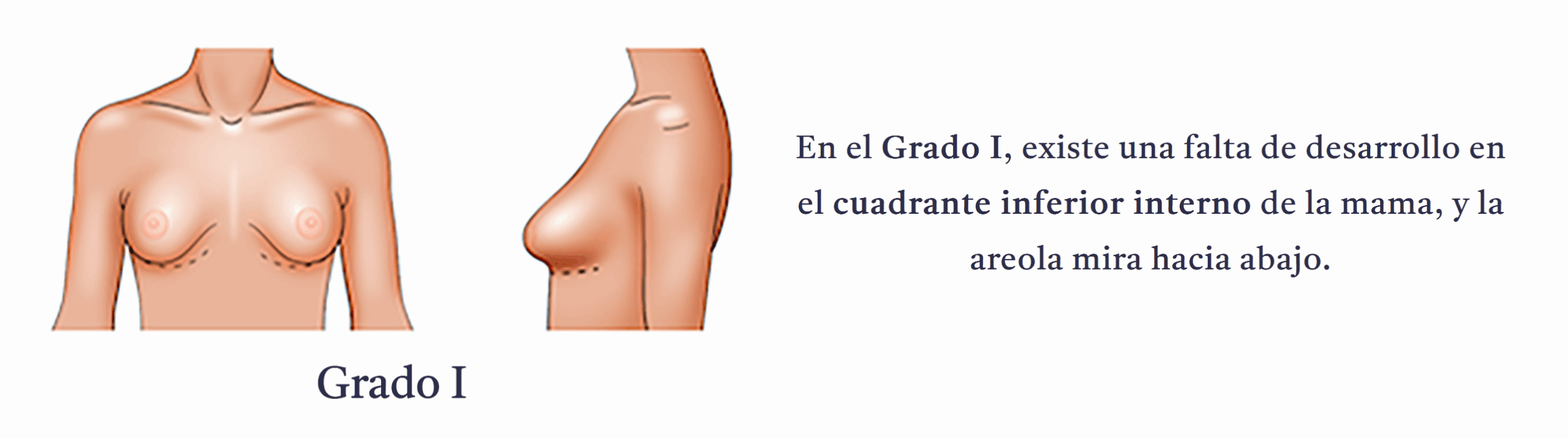 Grado 1