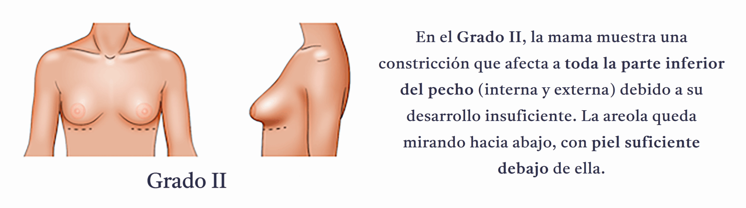 Grado 2