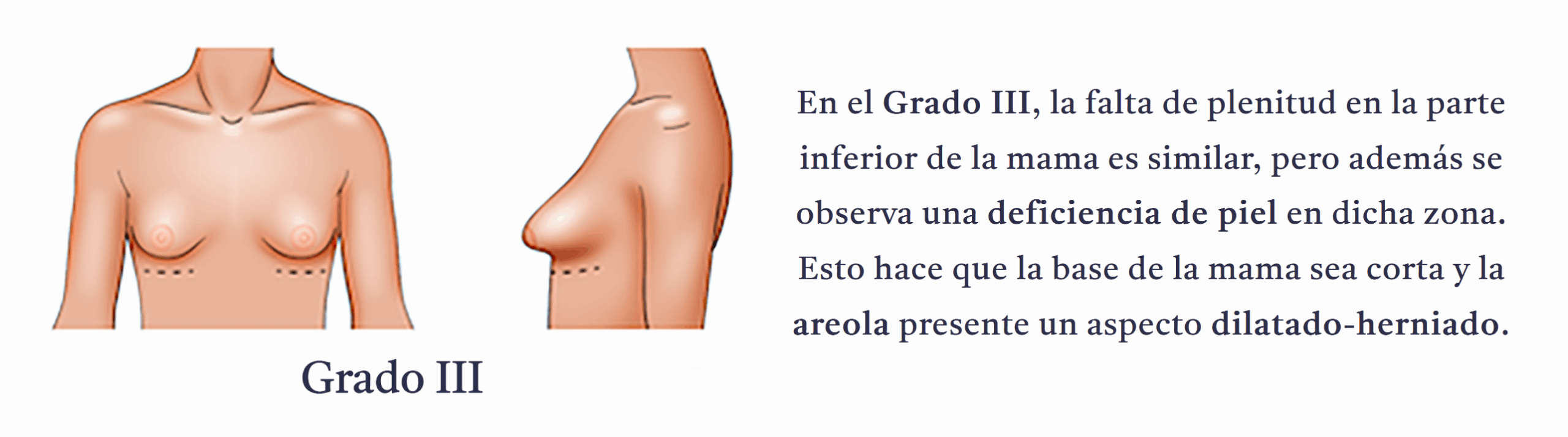 Grado 3