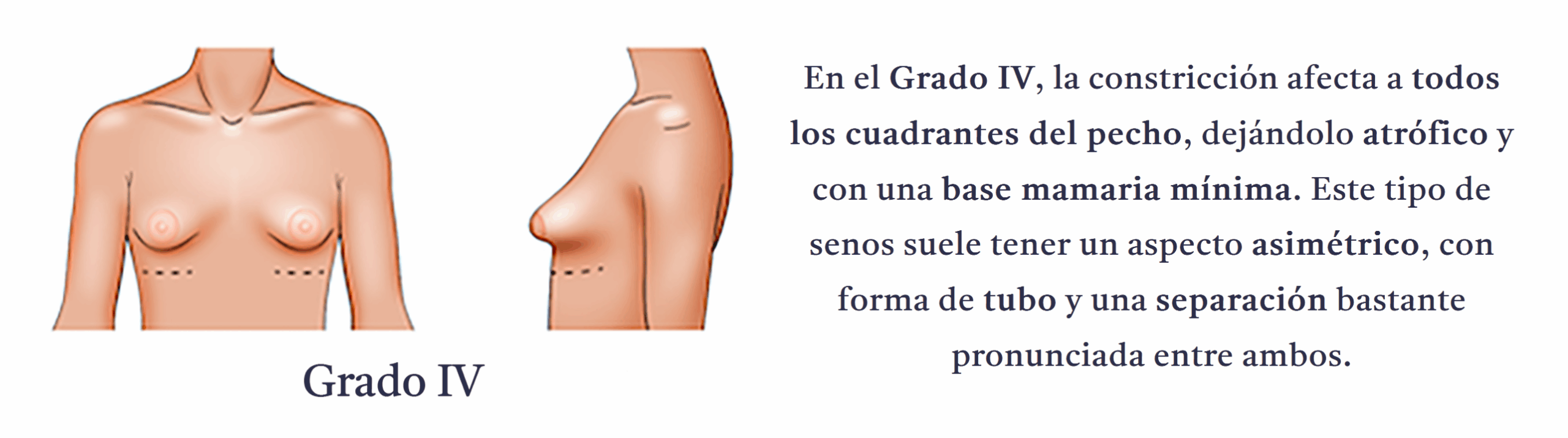 Grado 4