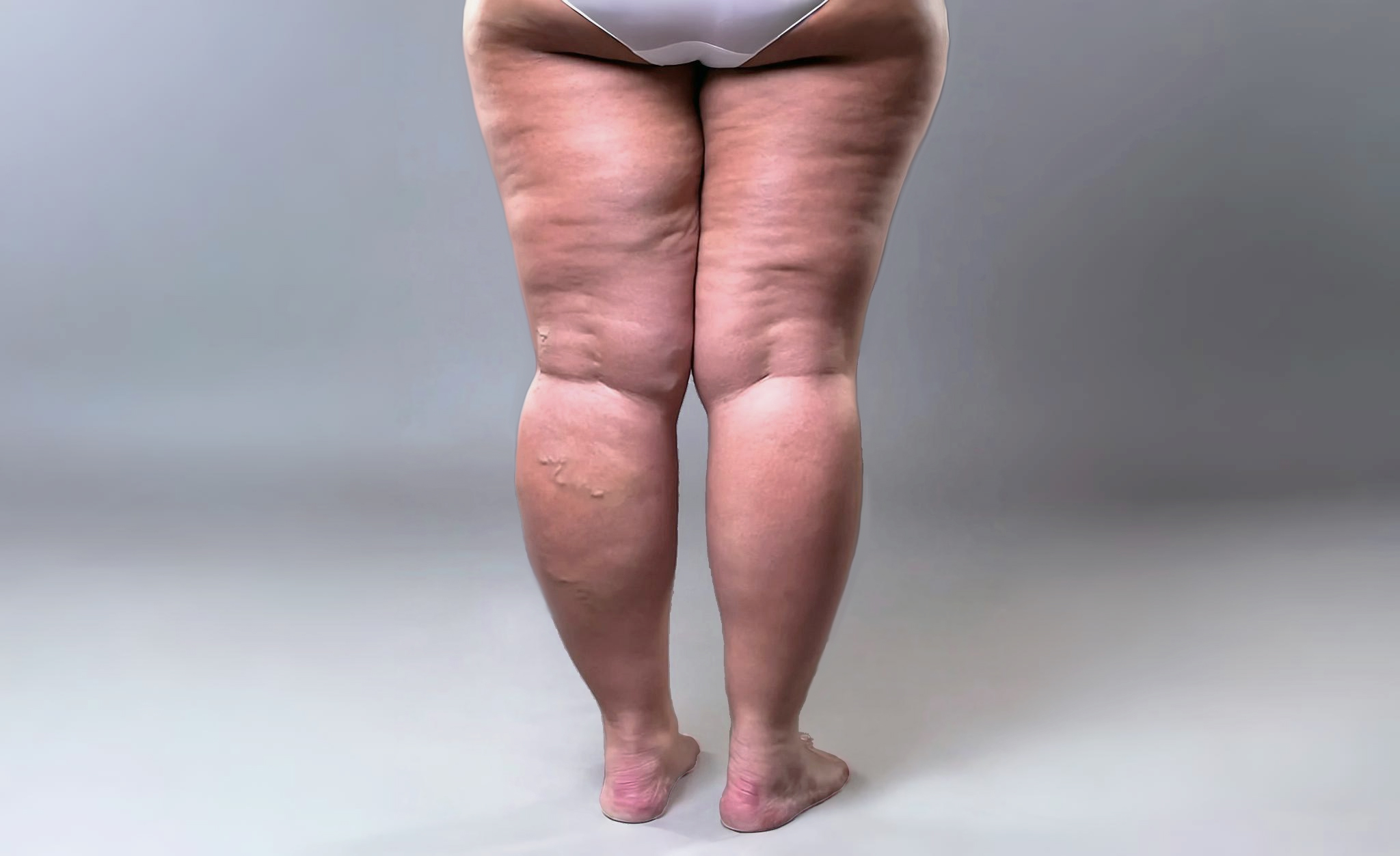 Lipedema4